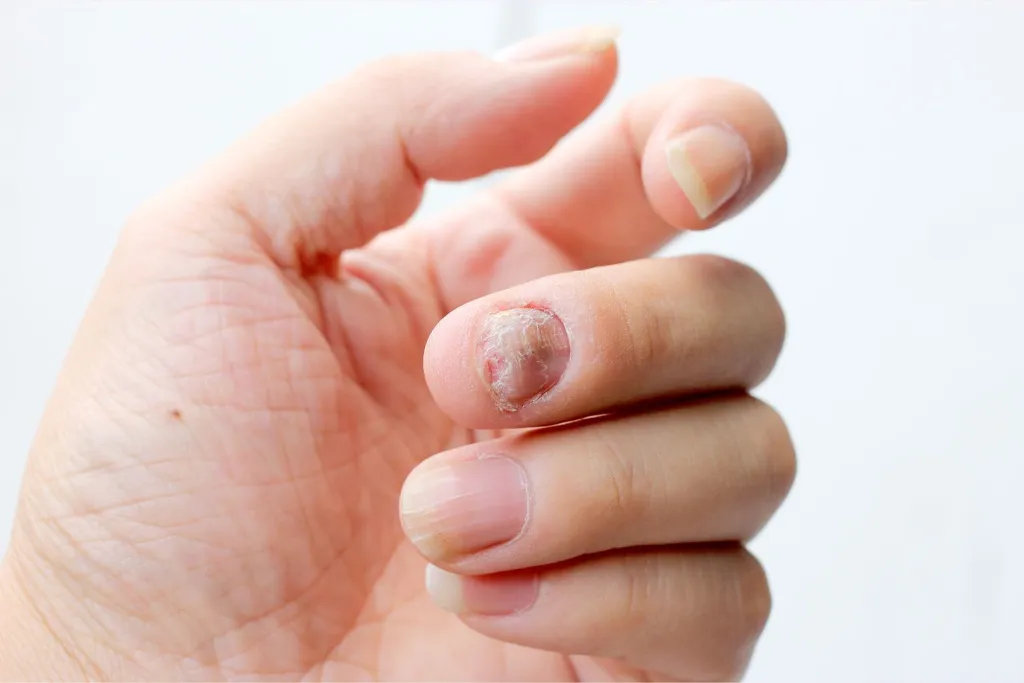 Guía Completa: Hongos en las Uñas + Remedios Naturales