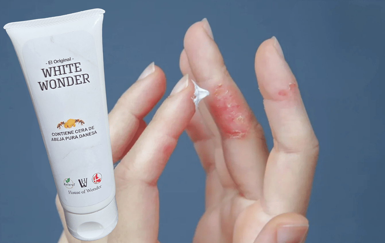 Psoriasis Remedios Naturales Alternativa Guía Completa