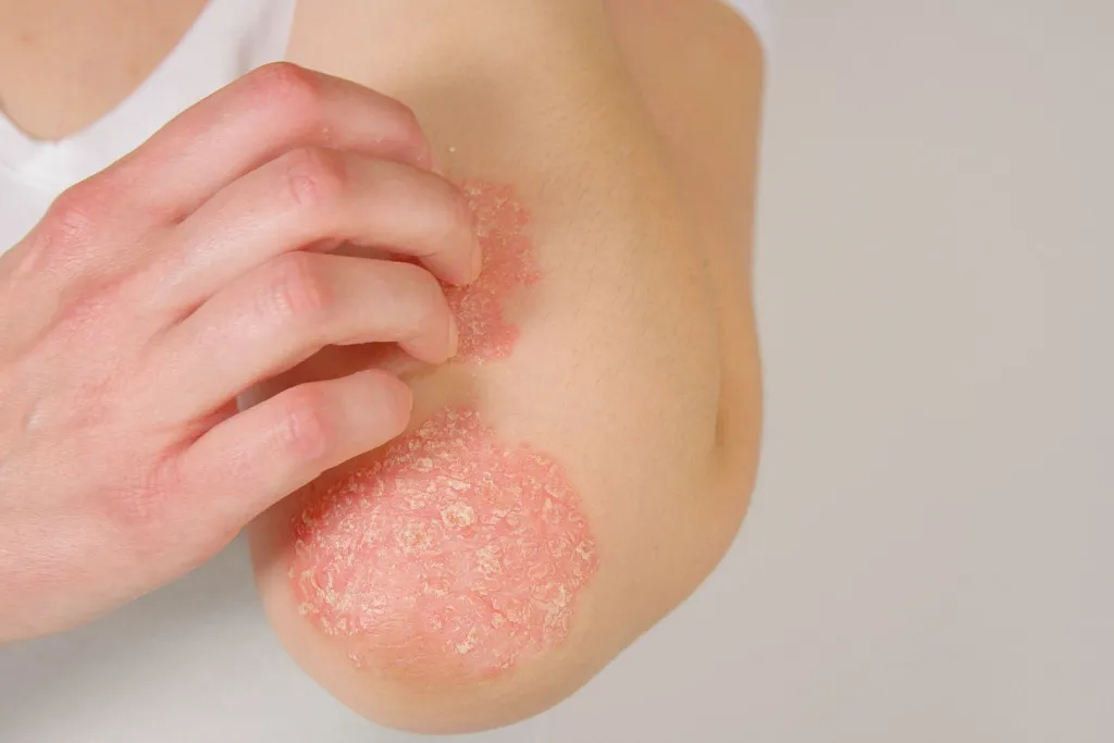 Psoriasis Tratamiento Natural comprobado y Efectivo