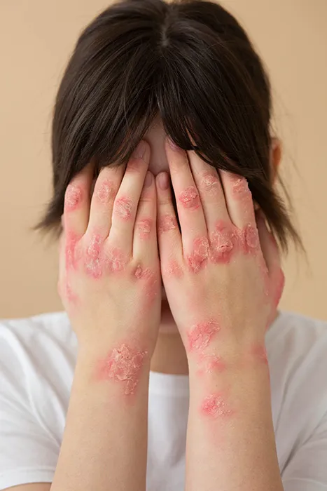 Psoriasis 1 Soriasis 2